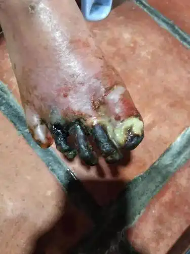 老人的脚烂成这样子,今年的三月份就开始到现在一直