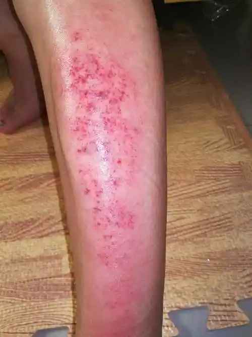 血毒/皮肤病/脓疮 - 简书