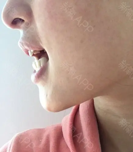 留念一下整牙前的照片,牙齿拥挤不齐,虎牙比较突出,_圈子-新氧美容