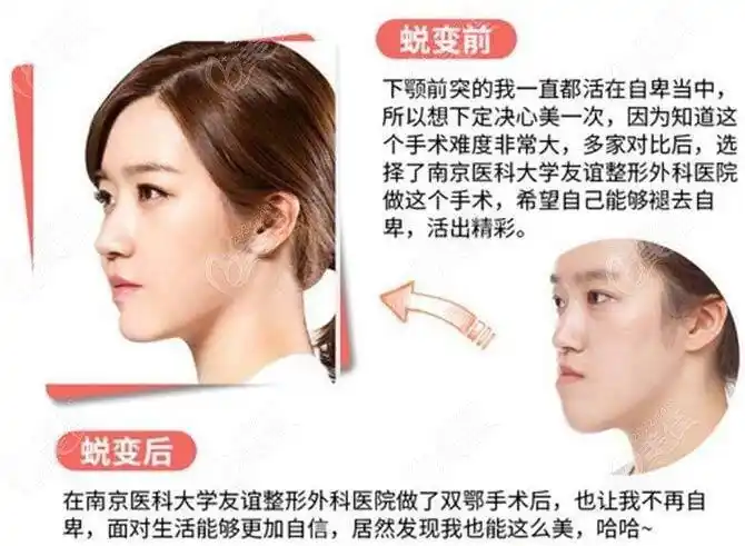 吴国平医生正颌手术前后对比照