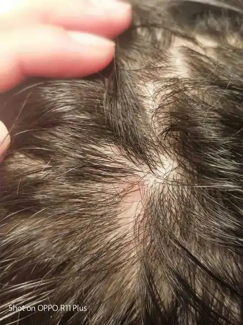 孩子头皮上有一块像癣一样的地方,出生的时候就有,当时没在意,现在八