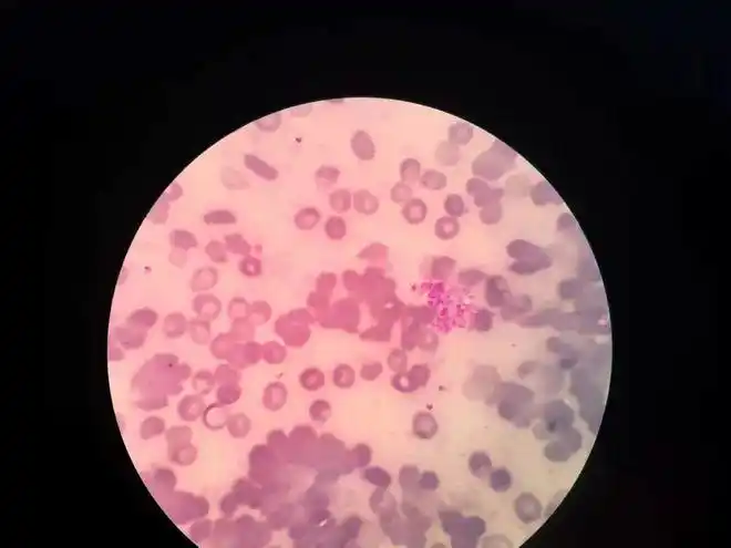 又用生理盐水洗涤红细胞三次后,重做血型,没有再发生弱凝集,结果为b型