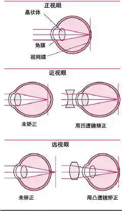 临安近视矫正价格低