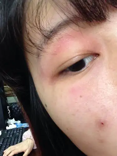 我这个是不是神经性皮炎吗,该怎么办,眼睛周围红肿,痒,皮块,快一个月