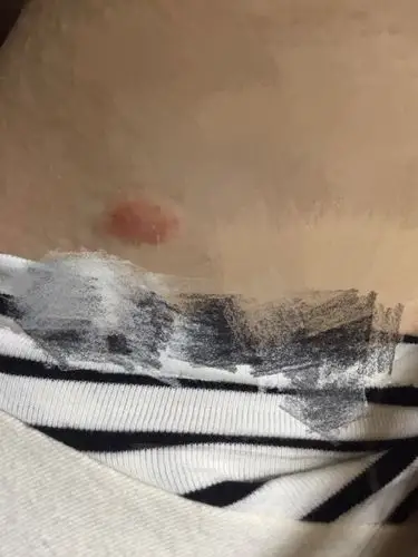 腋下长了一个胞 就像图里面这样 不疼也不痒 可能是什么原因?