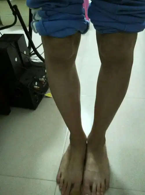 这是什么腿,他说这是内八字腿,我说这是外八字腿或者外八字o形腿