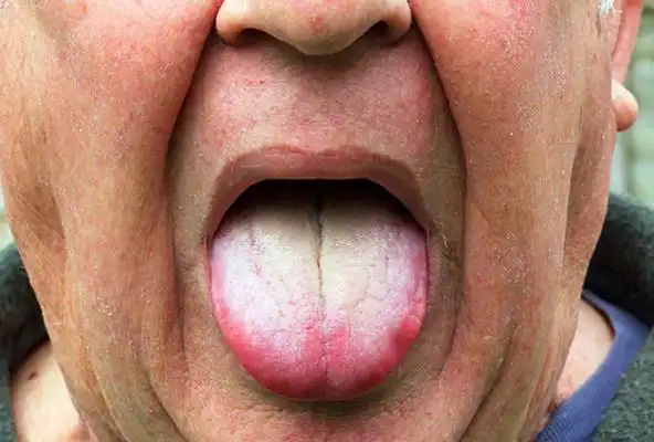 艾滋病的舌头白苔图片 (1)