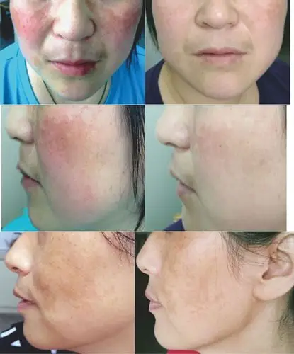 安舒贴美白保湿面膜(脸颊型)