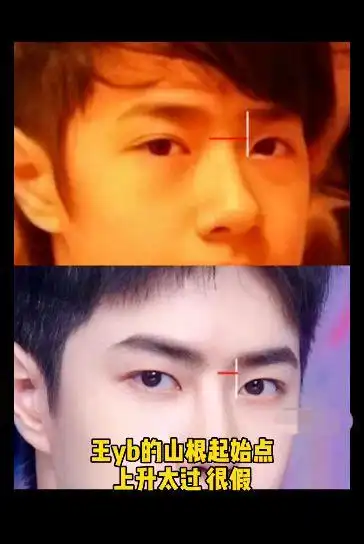 看脸博主直言王一博做了鼻翼缩小,还称其注射玻尿酸导致鼻子挛缩|整容