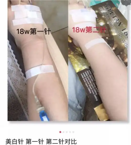 14天真人实测 | 女星们都离不开的美白针,用完黑色素变化有多惊人?