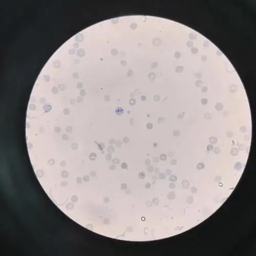 个胸腹水标本看细胞数细胞认细胞(正常红细胞,颗粒红细胞,棘形红细胞