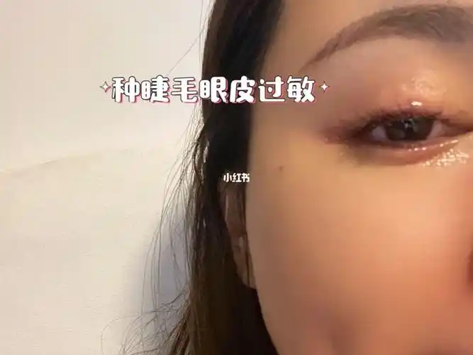 典必殊-种睫毛眼皮肿特效药膏【不可长期使用