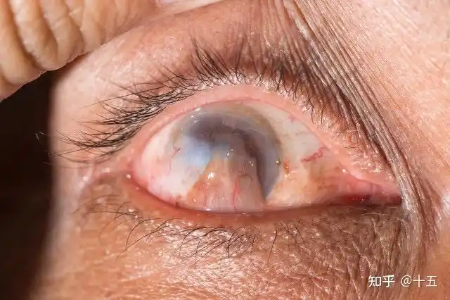 但是别担心,比起青光眼白内障这些眼病,翼状胬肉治疗是很简单的,做个