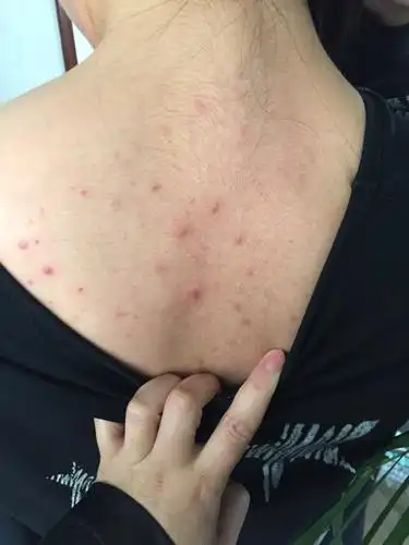 背上长了这么多痘痘怎么回事啊?