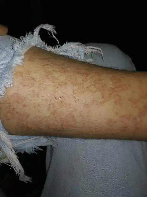 小腿以下出现深红色斑点