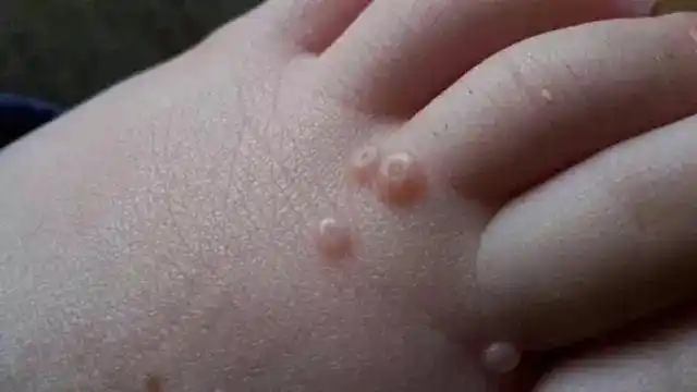 大好人生疣齐可怕如何做到人生无疣