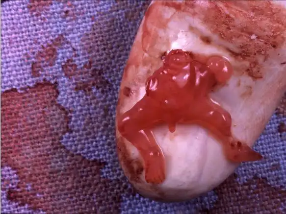 1) 早期堕胎:7周大的胎儿