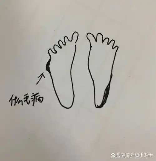 左脚小拇指骨头往外突出,如图,是什么毛病?