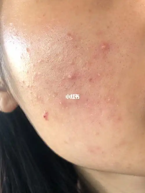 痘痘肌肤化妆三原则:这是肌的精简因为痘痘肌肤的皮肤耐受性较差,使用