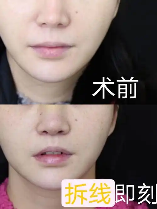 人中缩短术后7天手术医院:成都心悦容其实长脸和短脸_圈子-新氧美容