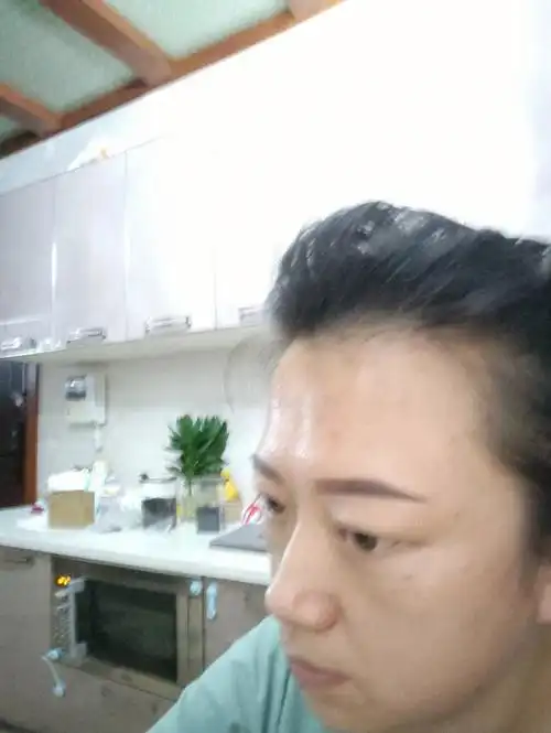 我的额头终于看着好看多了,后悔早填好了,三针玻尿酸,治好了我一直