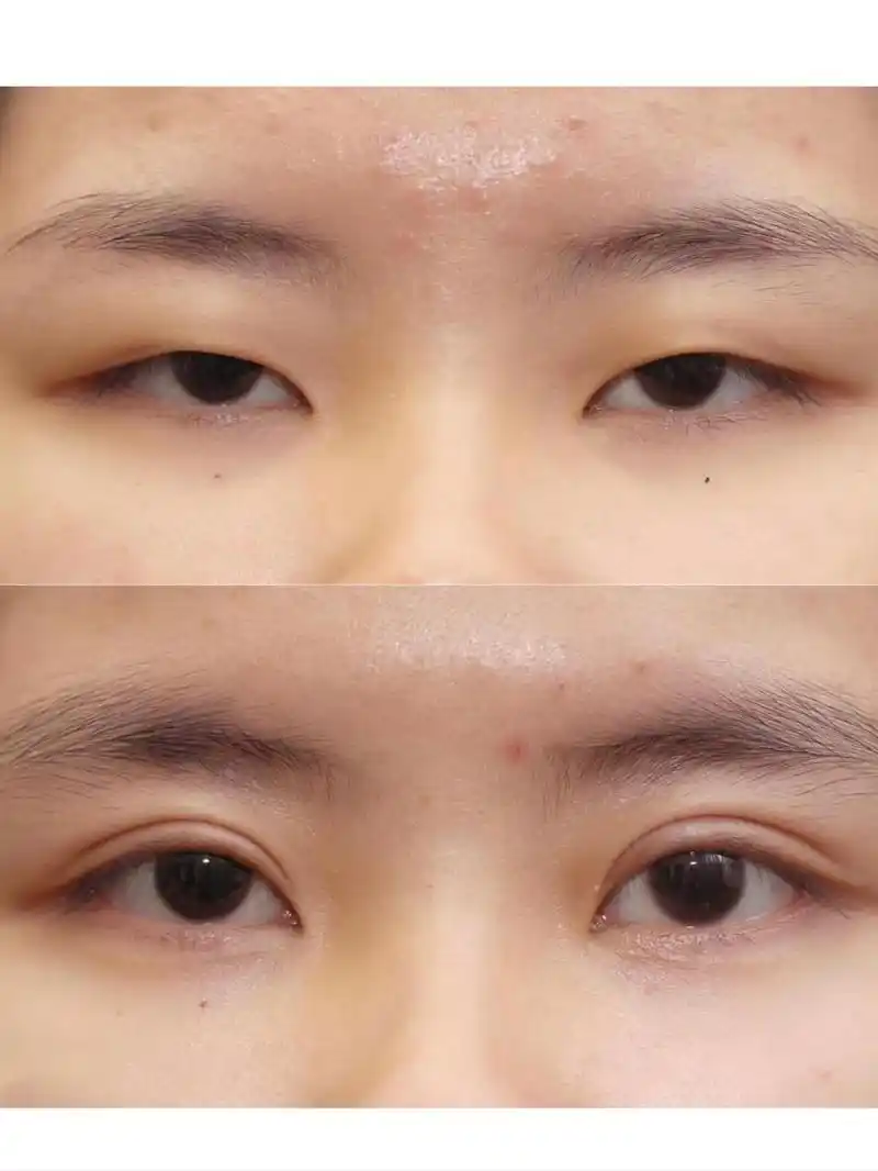 单眼皮上睑下垂严重,眼睛像睁不开,割完双眼皮后颜值提升不少