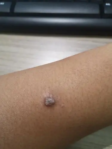 手臂上长了不知道是什么东西,半年鸡眼膏贴过两盒了