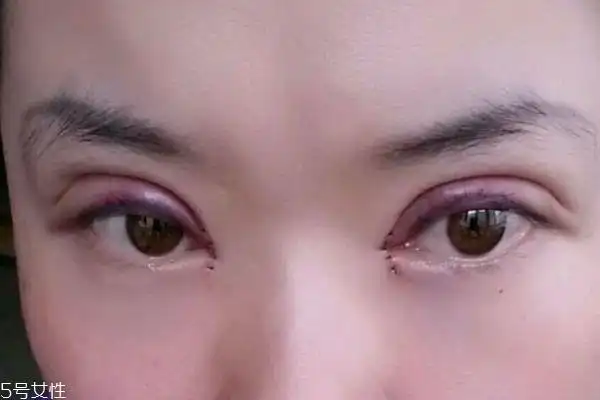 内双割双眼皮容易吗 割双眼皮有什么注意的呢