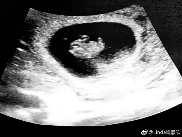 3月2日,钟嘉欣[微博]在微博上宣布自己已怀有二胎,并晒出了宝宝的b超