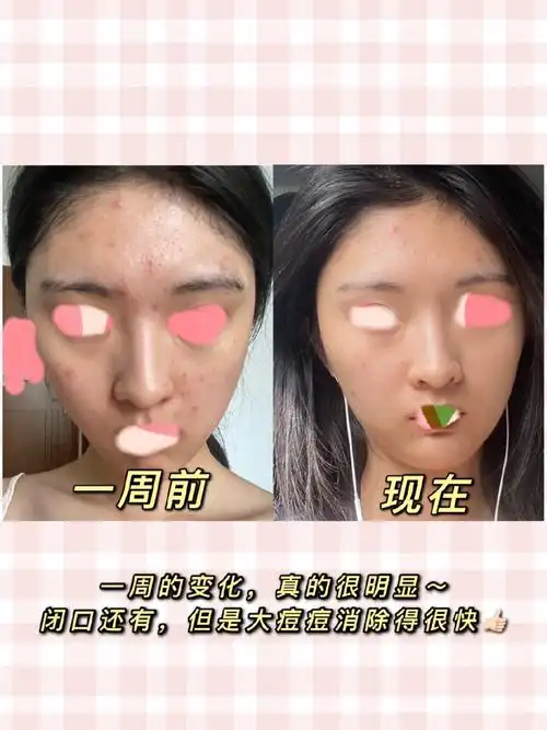 妍依净果酸换肤精华舒缓喷雾使用感受