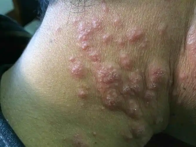 这是什么皮肤病 - 皮肤及性传播疾病讨论版 - 爱爱医医学论坛