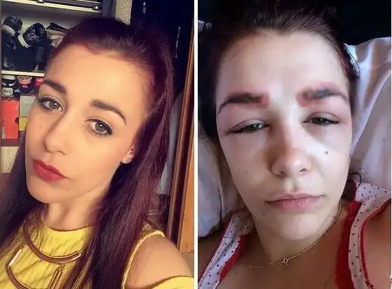 实拍整容失败惨遭毁容的6位女性看完你还敢整容吗