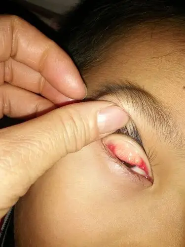 孩子眼皮里面这是什么东西?