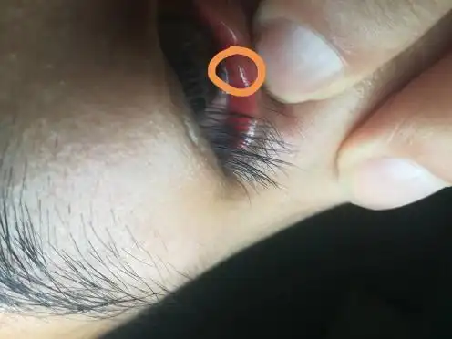 眼睛下眼皮里面有个东西特别难受有凸起而且有时候还能挤出半透明状的