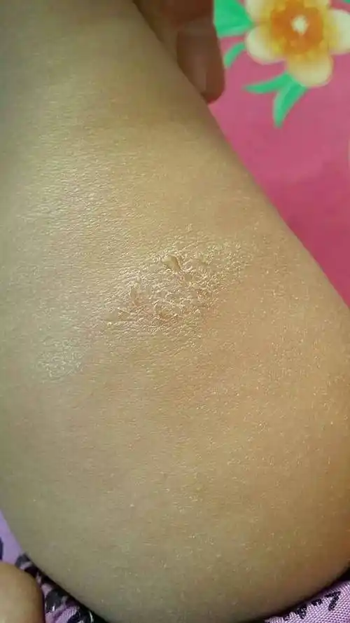 宝宝11个月大 腿上长了两块癣 请问是什么癣