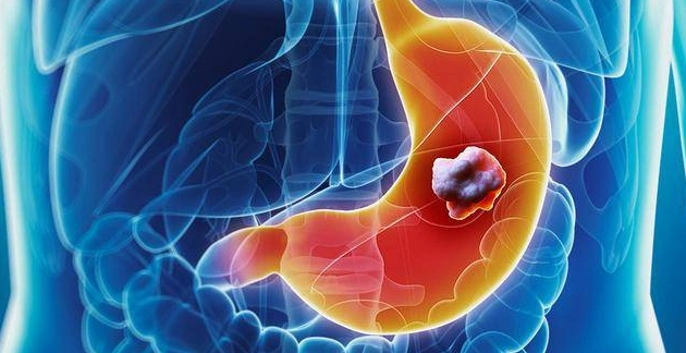 疼痛有周期性,疼一阵缓一阵,严重时会导致胃出血和胃穿孔,出现黑便等