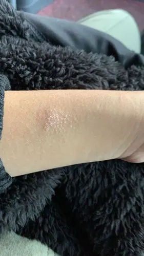 哪位大神帮我看看我这是得了什么癣吗?