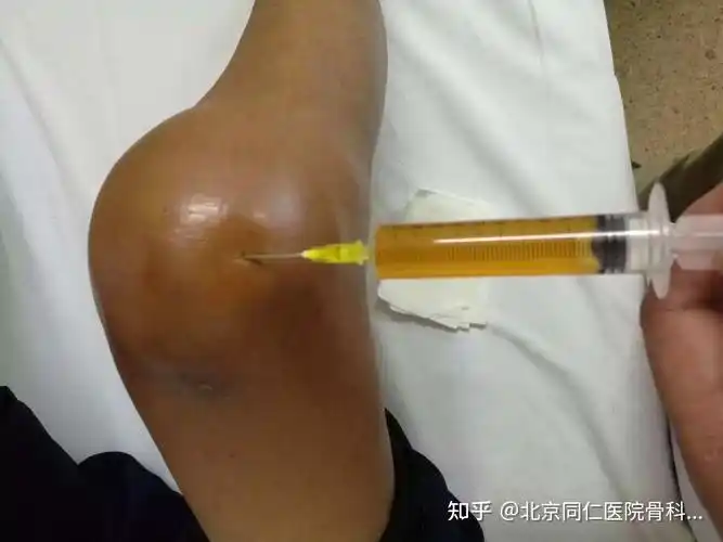 膝盖产生积液怎么处理? - 知乎