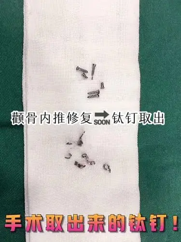 颧骨内推修复,钛钉钛板取出现场🔜轮廓术早期的技术需_圈子-新氧美