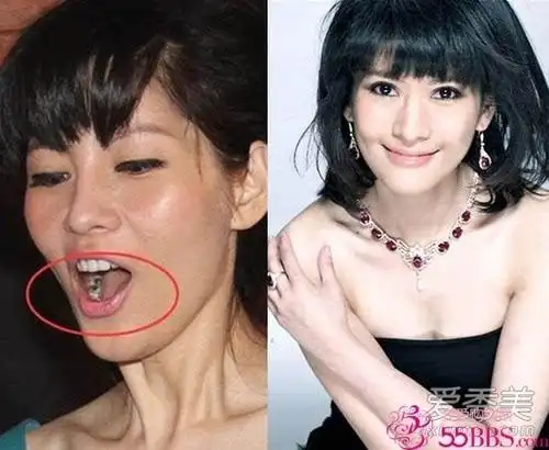 谢娜佟丽娅王珞丹一口烂牙毁掉高颜值