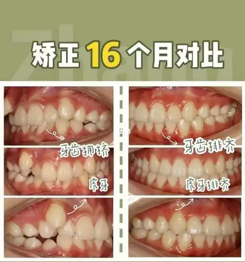 虎牙 牙齿拥挤 不拔牙方案 整体矫治时间16个月91小姐姐的气质一下