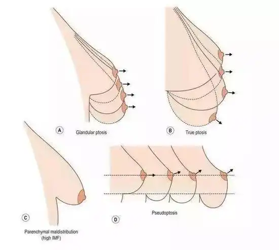 胸下垂|丰胸|乳房下垂_新浪女性_新浪网