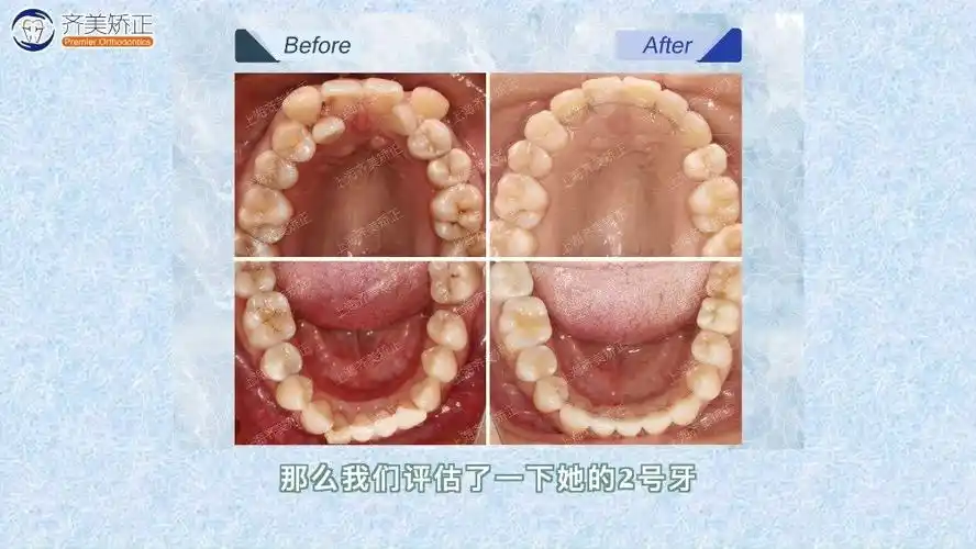 五星高难度复杂案例分享 这位女士的主要问题是牙齿拥挤,上颌有颗虎牙