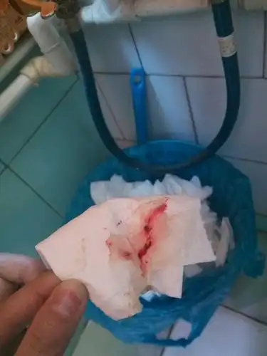 排卵期白带带血块血丝