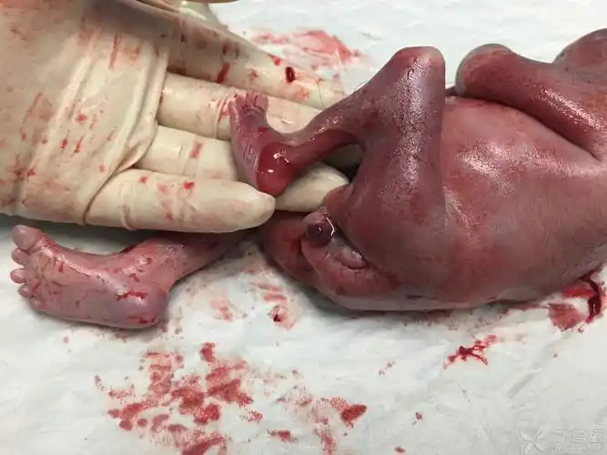 畸形引产 - 儿科专业讨论版 -丁香园论坛