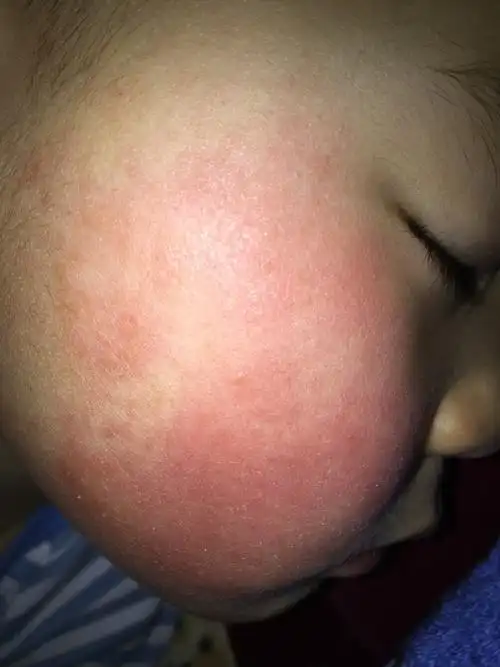 帮忙看看宝宝脸怎么了