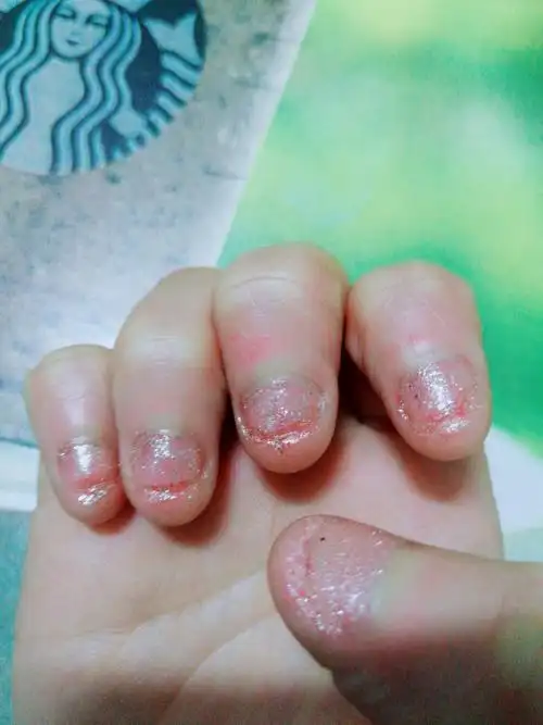 咬指甲怎么戒除