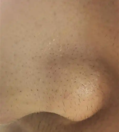 油性皮肤有黑头毛孔粗大怎么办?用什么能去除黑头和收缩毛孔?