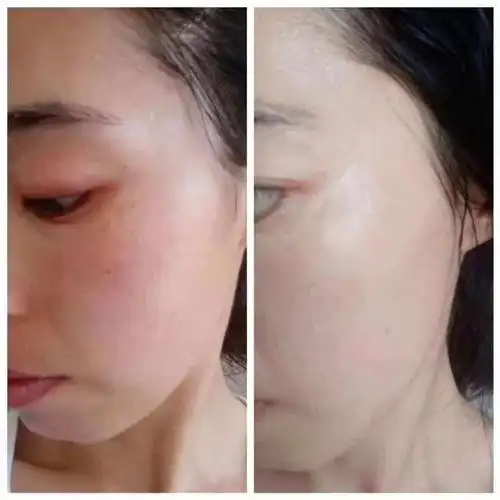 什么是脸部角质层修复脸部角质层的方法和技巧有哪些