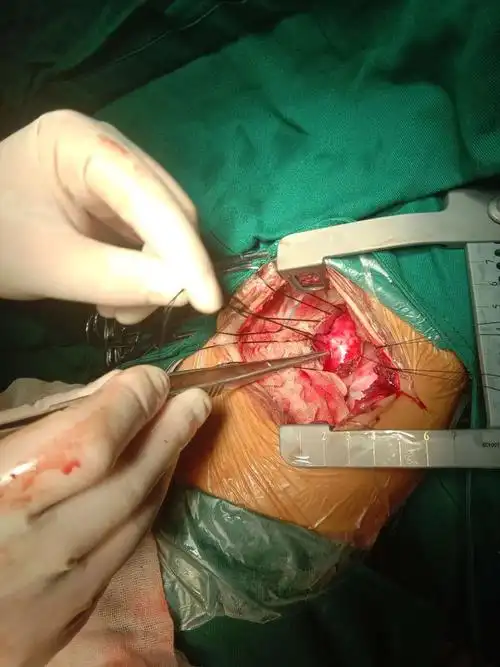 麻醉师反复膨肺使肺复张,安置胸腔闭式引流管,逐层缝合手术切口关胸